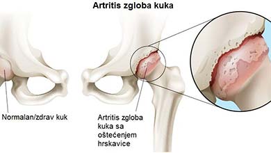Artritis zgloba kuka