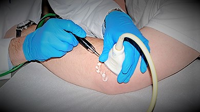 Ultrazvučno navođeno davanje blokade u predeo lakta