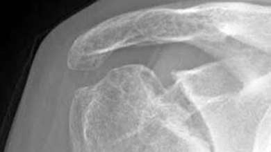 Avaskularna nekroza - rendgenski snimak