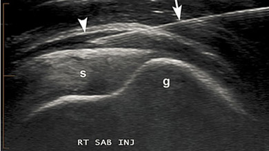 Ultrazvučni snimak davanja blokade u burzu ramena
