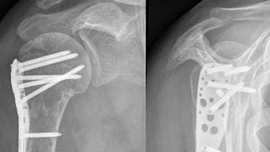 Osteosinteza preloma ramena - rendgenski snimak