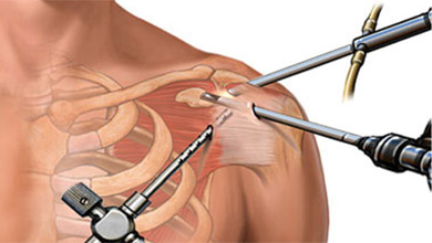 Artroskopija ramena