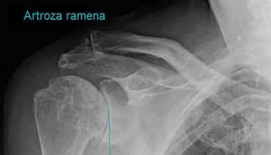 Artroza ramena - rendgenski snimak