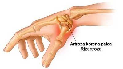 Artroza korena palca (rizartroza)