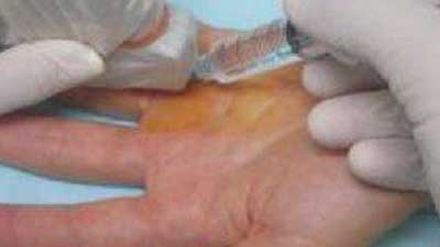 Dipitrenova kontraktura - ultrazvučno navođenje injekcije kortikosteroida