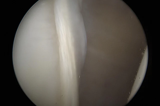 Artroskopski nalaz – normalno rame