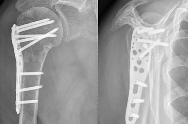 Osteosinteza preloma ramena, rendgenski snimak