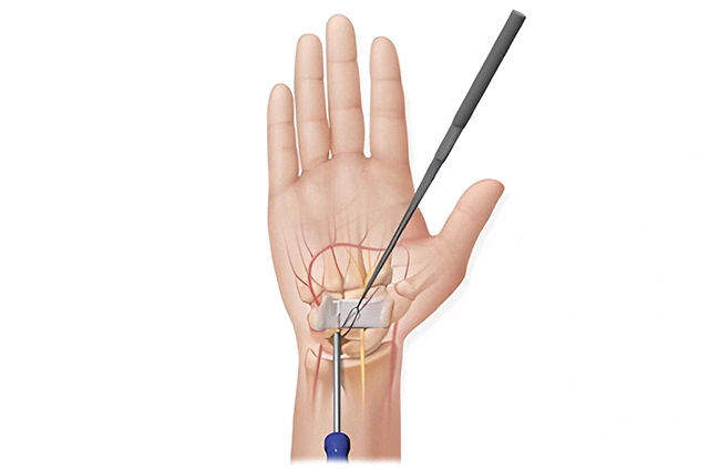 Dekompresija karpalnog tunela – artroskopska procedura